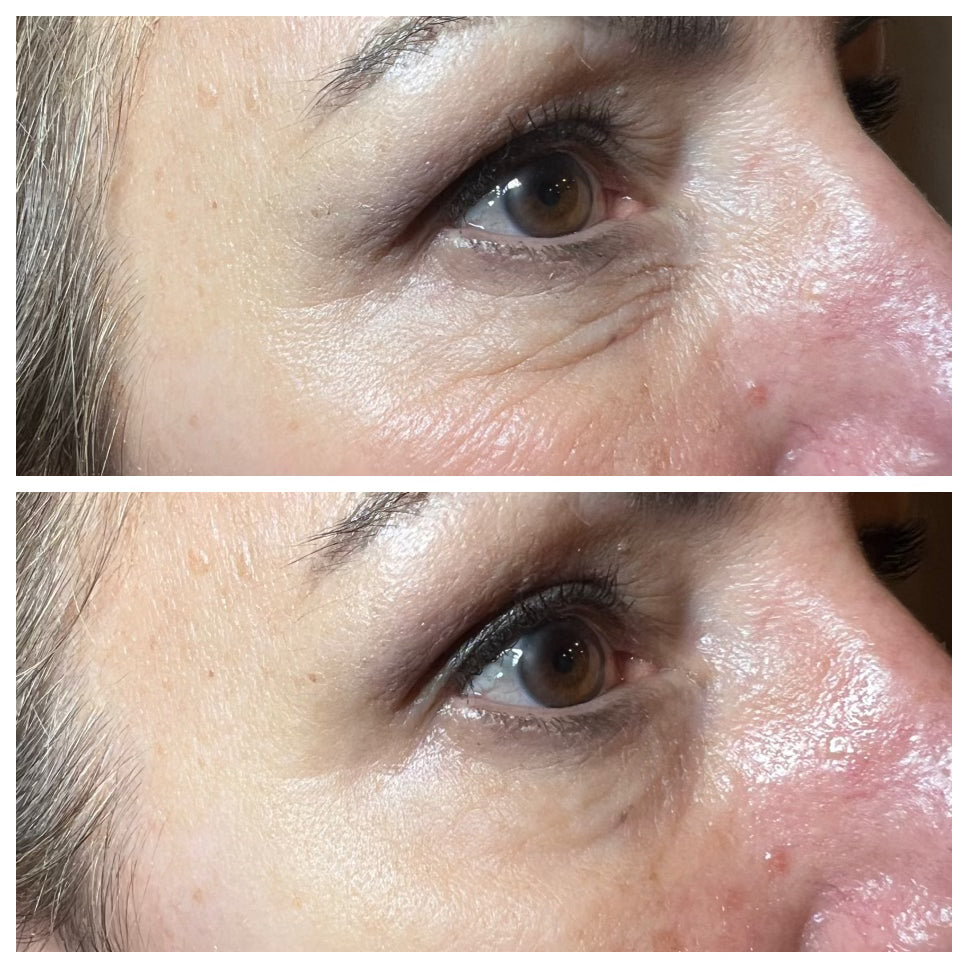 Instant Eye Lift (4 Treatments)